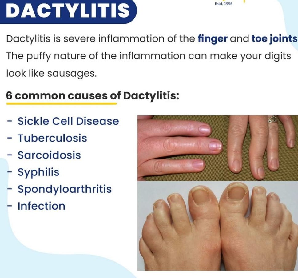 <a href="/IhabFathiSulima/">Dr Ihab Suliman</a> There is inflammation of the digits ->> called dactylitis 

:Dactylitis is a complication of sickle cell anaemia 
Others includes 
Pain 
Acute chest syndrome 
Low o2 perfusion
<approach >.
O2 supplementation +fluids + pain meds -morphine body/kg 4hrly 

Infection prevention