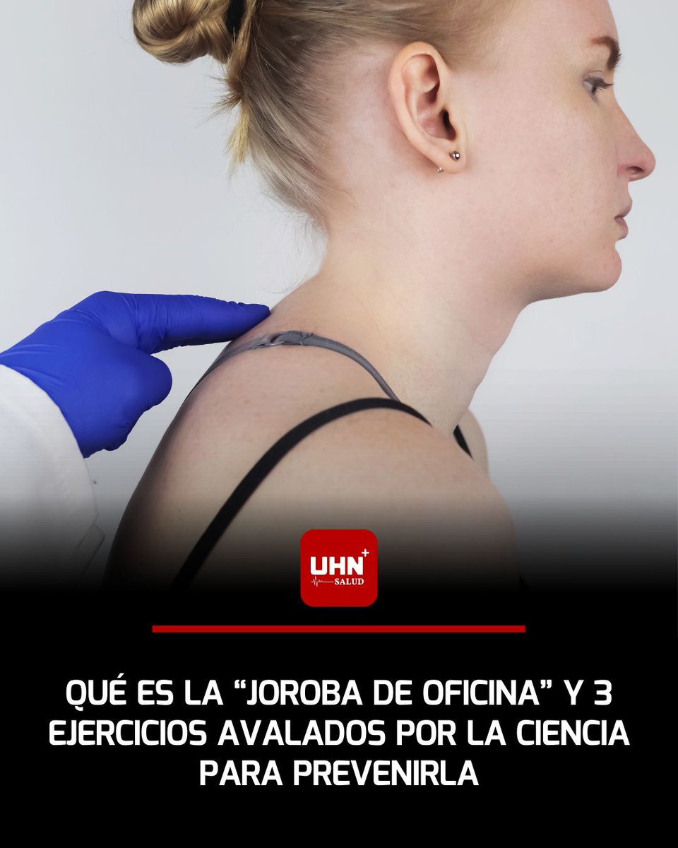 🦴‼️ | ¿QUÉ ES LA “JOROBA DE OFICINA” Y CÓMO PREVENIRLA? — La llamada “joroba de oficina” se refiere a la hipercifosis postural provocada por largas horas frente al computador con la cabeza adelantada y los hombros encorvados. Esta mala postura sostenida puede generar dolor
