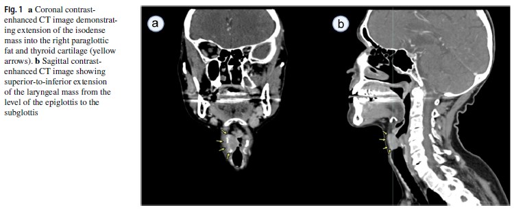 KirillLyapichev's tweet photo. Publication in Virchow Archiv @ESP_Pathology @SpringerPath 

Grateful to @CleveClinicFL and international team: future pathology 🌟: Griffin Willman &amp; @ZohreSdgh96; Drs. Fu, Kochiyil, Trosman, @Gulrukh_G, Pak, Chernov, Abdukhalikov &amp; @AmirBehdadMD #MedEd #hemepath #pathedu #PathX https://t.co/JmhBdxqlKv