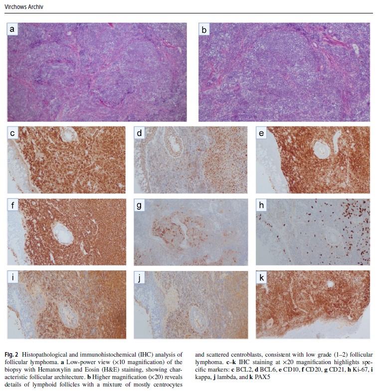KirillLyapichev's tweet photo. Publication in Virchow Archiv @ESP_Pathology @SpringerPath 

Grateful to @CleveClinicFL and international team: future pathology 🌟: Griffin Willman &amp; @ZohreSdgh96; Drs. Fu, Kochiyil, Trosman, @Gulrukh_G, Pak, Chernov, Abdukhalikov &amp; @AmirBehdadMD #MedEd #hemepath #pathedu #PathX https://t.co/JmhBdxqlKv