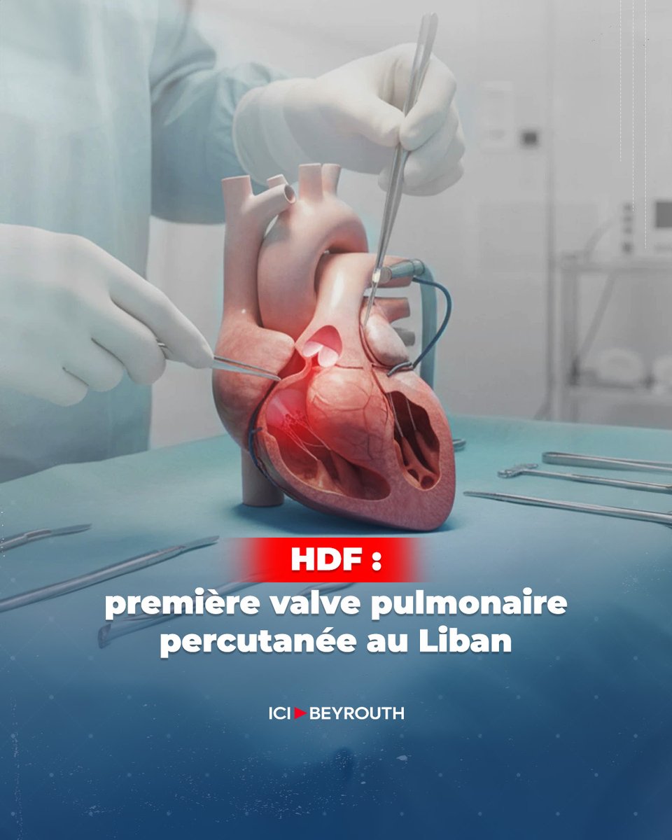 Icibeyrouthnews's tweet photo. Le Pr #ZakhiaSaliba a réalisé à l’#Hôtel-Dieu de France une première au #Liban: l’#implantation d’une valve pulmonaire auto-expansible par cathétérisme.
Une nouvelle option pour des patients déjà opérés à #cœur ouvert.
@USJLiban
Pour en savoir plus, lisez l’article de Makram Haddad sur #IciBeyrouth via le lien: https://t.co/ylmNePDwvc