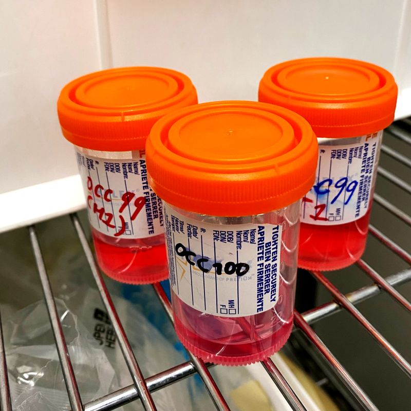 Important milestone for <a href="/Sunnybrook/">Sunnybrook Health Sciences Centre</a> NETs team: 1️⃣0️⃣0️⃣th patient enrolled in the NEN Biobank! 🎉thanks to <a href="/IacovosMichael/">iacovos michael 🇨🇦</a>, Hubert Tsui &amp; their teams 👏

Grateful to the patients &amp; families who choose to participate in research. These samples are already advancing NETs research🧪