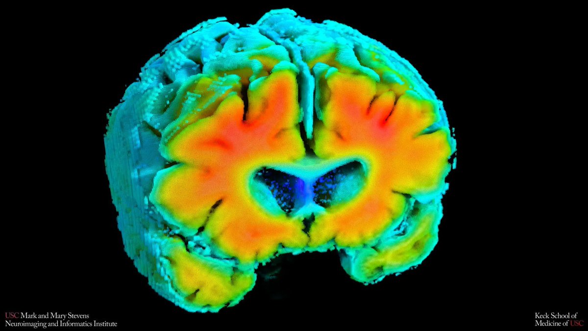 DiverseElders's tweet image. Subtle changes in #brain blood #flow and #oxygen are closely linked to hallmark #signs of #Alzheimers, including plaques and memory-related brain shrinkage. Noninvasive #scans may one day #help spot risk #earlier by looking at the #brain’s vascular #health buff.ly/iFglFhS