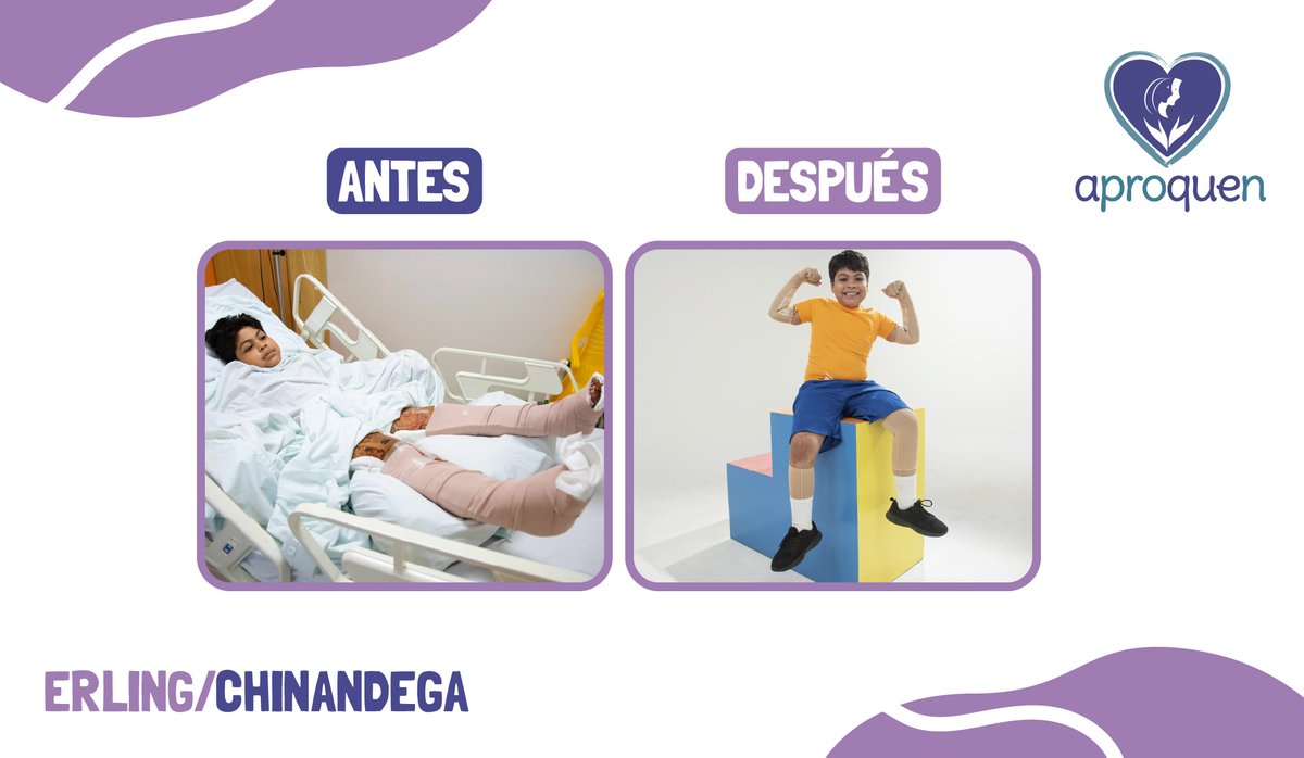 APROQUEN1's tweet photo. Un día, mientras acompañaba a su mamá por los caminos de Chinandega, Erling sufrió quemaduras al resbalar sobre ceniza de basura recién quemada que aún estaba caliente, provocándole quemaduras de segundo y tercer grado en brazos y piernas. https://t.co/HnB0JGcbOR