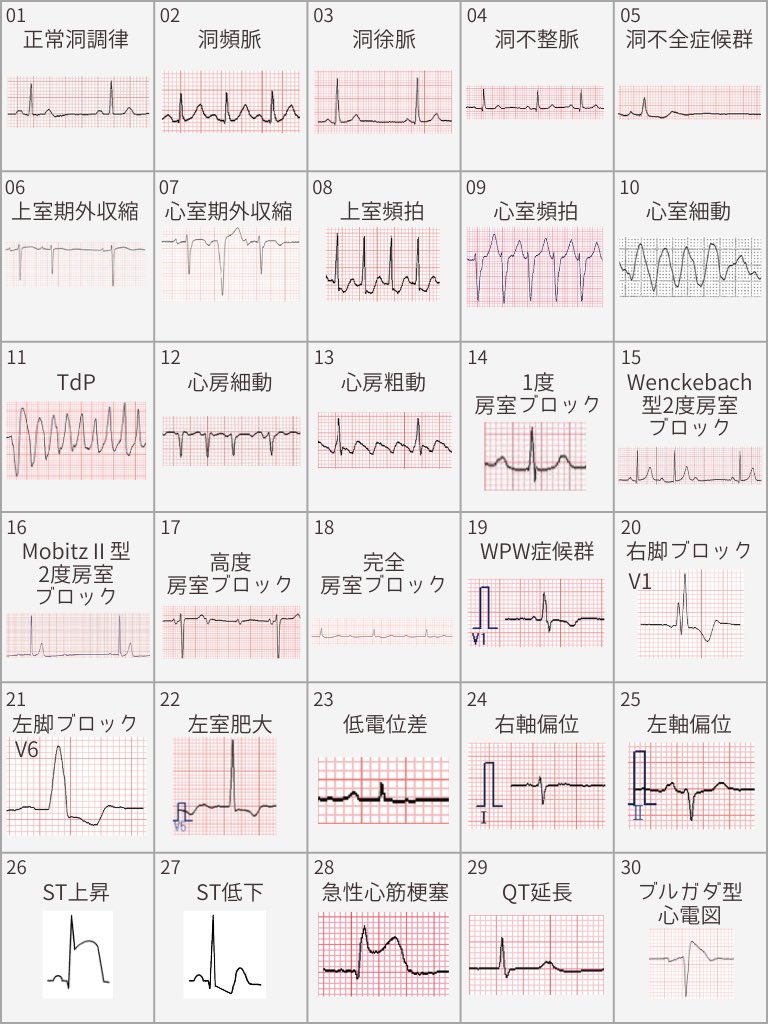 ecgkuma's tweet photo. 心電図、どこから始めればいいか分からない。
それは、優先順位が示されていないからです。

でも安心してください。

まずは、この30から始めましょう。

・臨床でよく遭遇する
・緊急度判断に直結する
・心電図検定の基礎を網羅している

「最初にやるべき波形」を抽出したものです。

すべてを丸暗記する必要はありません。
重要なのは、名前ではなく構造。

【本質】何が起きているのか
【機序】なぜその波形になるのか
【臨床】出会ったらどう動くか
【検定】どう問われるか

この4点で整理すること。
これが、応用に耐える学び方です。

⸻

★臨床的目安

★★★★★＝即対応
★★★★☆＝早急評価
★★★☆☆＝注意深く評価
★★☆☆☆＝経過観察中心
★☆☆☆☆＝基本的に生理的

01 正常洞調律 ★☆☆☆☆
【本質】基準
【機序】洞結節から正常伝導
【臨床】すべての比較の出発点
【検定】HR・PQ・QRS・QT基準

02 洞頻脈 ★★☆☆☆
【本質】速い洞調律
【機序】交感神経亢進
【臨床】発熱・脱水など原因検索
【検定】100/分以上

03 洞徐脈 ★★☆☆☆（症状あれば★★★★☆）
【本質】遅い洞調律
【機序】迷走神経優位
【臨床】失神・薬剤確認
【検定】60/分未満

04 洞不整脈 ★☆☆☆☆
【本質】呼吸性変動
【機序】迷走神経トーン変動
【臨床】若年では生理的
【検定】RR間隔変動

05 洞不全症候群 ★★★★☆
【本質】洞停止
【機序】洞結節機能低下
【臨床】失神→ペースメーカー評価
【検定】洞停止所見

06 上室期外収縮 ★★☆☆☆
【本質】狭QRSの早期収縮
【機序】上室異所性興奮
【臨床】頻発なら背景評価
【検定】正常幅QRS

07 心室期外収縮 ★★★☆☆
【本質】広QRSの早期収縮
【機序】心室異所性自動能
【臨床】連発・多形性に注意
【検定】幅広QRS

08 上室頻拍 ★★★☆☆
【本質】狭く速い規則頻拍
【機序】リエントリー
【臨床】血圧・症状確認
【検定】狭QRS頻拍

09 心室頻拍 ★★★★★
【本質】広く速い危険頻拍
【機序】心室内リエントリー
【臨床】ショック適応判断
【検定】AV解離

10 心室細動 ★★★★★
【本質】拍出ゼロ
【機序】無秩序興奮
【臨床】即除細動
【検定】識別不能波形

11 TdP ★★★★★
【本質】ねじれるVT
【機序】QT延長→EAD
【臨床】Mg投与
【検定】QT延長

12 心房細動 ★★★☆☆
【本質】P波なし・完全不規則
【機序】多発リエントリー
【臨床】レート管理・抗凝固評価
【検定】RR完全不規則

13 心房粗動 ★★★☆☆
【本質】ノコギリ波
【機序】単一リエントリー
【臨床】150/分前後に注意
【検定】F波

14 1度房室ブロック ★★☆☆☆
【本質】PQ延長
【機序】AV結節伝導遅延
【臨床】多くは経過観察
【検定】0.20秒以上

15 Wenckebach ★★☆☆☆
【本質】延びて脱落
【機序】AV結節疲労
【臨床】多くは良性
【検定】周期的延長

16 MobitzⅡ ★★★★☆
【本質】突然脱落
【機序】ヒス束以下障害
【臨床】高度化を警戒
【検定】PQ一定＋脱落

17 高度房室ブロック ★★★★☆
【本質】重度伝導障害
【機序】伝導途絶
【臨床】徐脈症状確認
【検定】伝導比異常

18 完全房室ブロック ★★★★★
【本質】AV解離
【機序】完全遮断
【臨床】緊急ペーシング
【検定】PとQRS無関係

19 WPW ★★★☆☆（AF合併で★★★★★）
【本質】副伝導路
【機序】早期心室興奮
【臨床】禁忌薬に注意
【検定】Δ波＋PQ短縮

20 右脚ブロック ★★☆☆☆
【本質】右室伝導遅延
【機序】右脚遮断
【臨床】急性なら肺塞栓鑑別
【検定】V1 rsR'

21 左脚ブロック ★★★☆☆
【本質】左室伝導遅延
【機序】左脚遮断
【臨床】新規なら虚血疑い
【検定】幅広R波

22 左室肥大 ★★☆☆☆
【本質】高電位
【機序】心筋肥大
【臨床】高血圧評価
【検定】電位基準

23 低電位差 ★★★☆☆
【本質】振幅低下
【機序】電気減衰
【臨床】心嚢液貯留鑑別
【検定】全誘導低電位

24 右軸偏位 ★★☆☆☆
【本質】右軸
【機序】右室優位
【臨床】右室負荷評価
【検定】I陰性

25 左軸偏位 ★★☆☆☆
【本質】左軸
【機序】左脚前枝ブロック
【臨床】伝導障害疑い
【検定】aVF陰性

26 ST上昇 ★★★★★
【本質】貫壁性虚血
【機序】傷害電流
【臨床】即ドクターコール
【検定】2誘導以上

27 ST低下 ★★★☆☆
【本質】心内膜下虚血
【機序】部分虚血
【臨床】経時変化確認
【検定】水平型・下降型が重要

28 急性心筋梗塞 ★★★★★
【本質】心筋壊死
【機序】冠動脈閉塞
【臨床】再灌流時間管理
【検定】虚血の時系列を追う

29 QT延長 ★★★★☆
【本質】再分極遅延
【機序】K電流低下
【臨床】薬剤・電解質確認
【検定】QTc基準

30 ブルガダ型 ★★★★★
【本質】突然死リスク
【機序】Naチャネル異常
【臨床】専門医紹介
【検定】V1–3特異的ST形態

※緊急度は症状・血行動態によって変わります。

保存しておくと、必ず役に立つ瞬間が来ます。