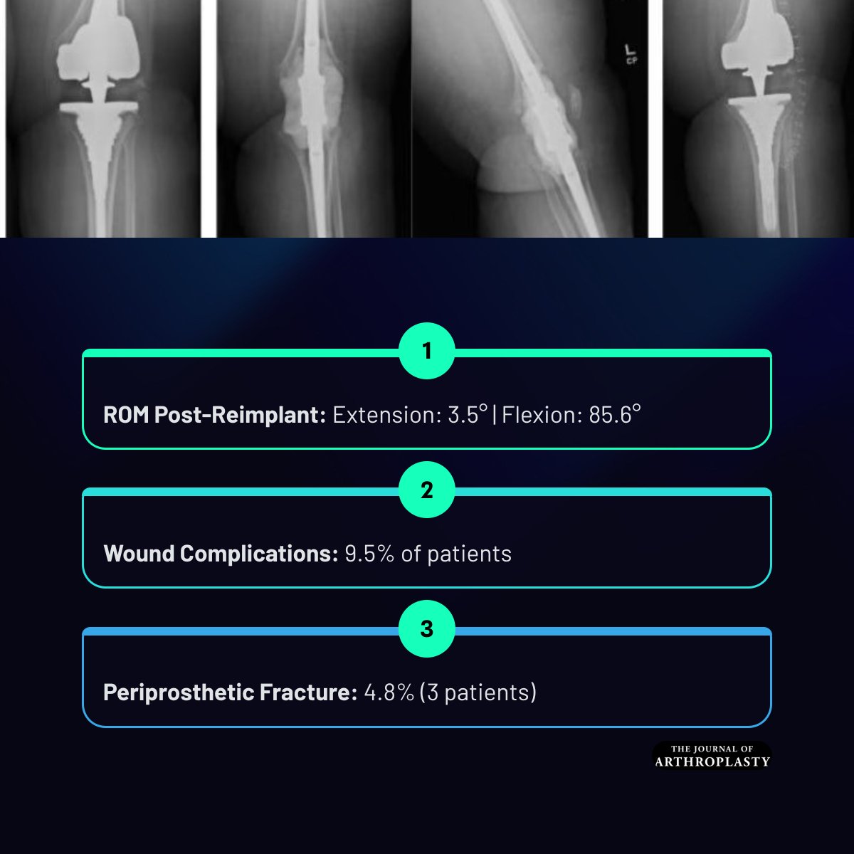 JArthroplasty's tweet photo. The modular knee fusion nail spacer has favorable survivorship, acceptable reinfection rates, and low mechanical complication rates in patients who have chronic knee PJI, many of whom present with severe bone loss, soft-tissue compromise, and instability.

https://t.co/W6roKaxUNN https://t.co/hPqQXF2MYF