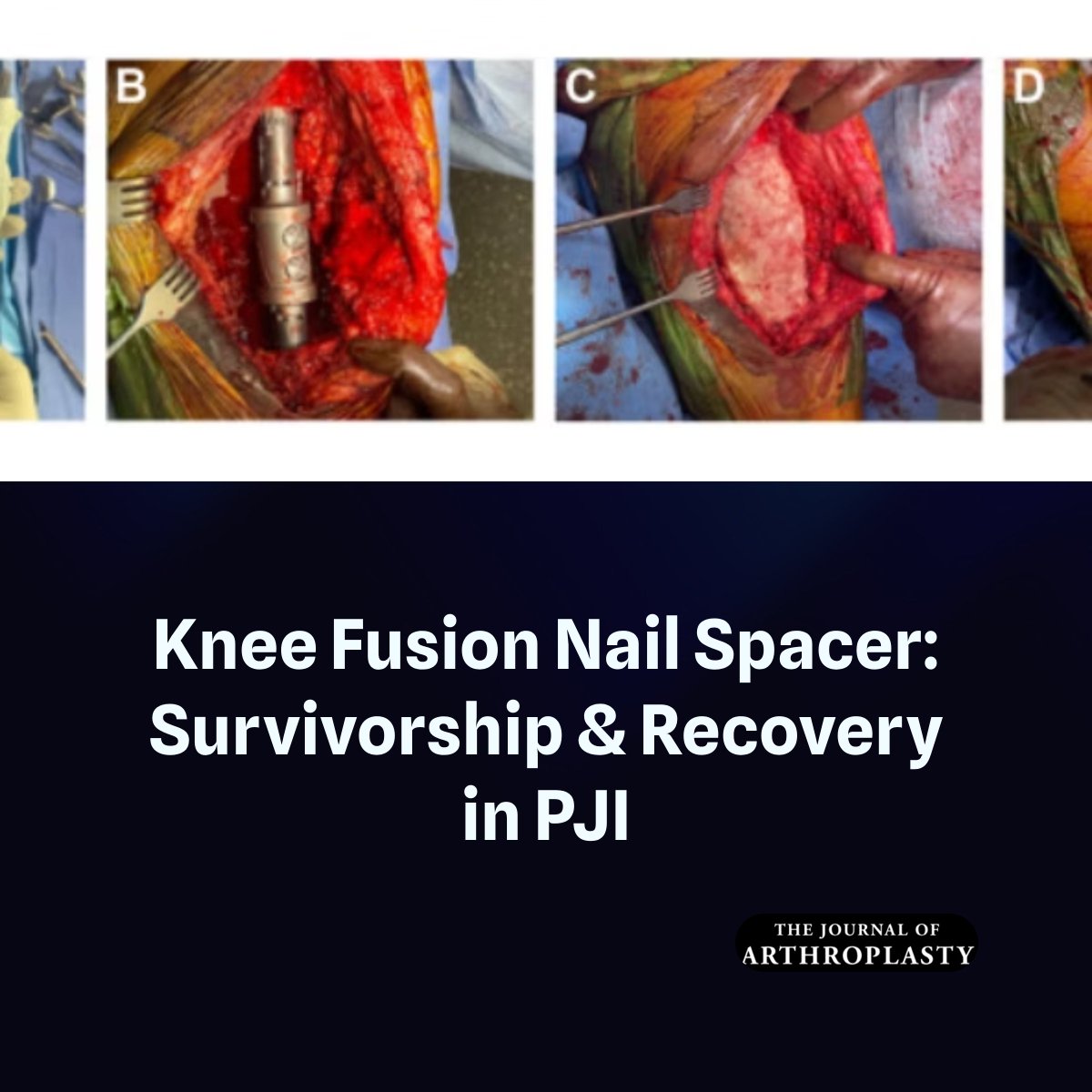 JArthroplasty's tweet photo. The modular knee fusion nail spacer has favorable survivorship, acceptable reinfection rates, and low mechanical complication rates in patients who have chronic knee PJI, many of whom present with severe bone loss, soft-tissue compromise, and instability.

https://t.co/W6roKaxUNN https://t.co/hPqQXF2MYF
