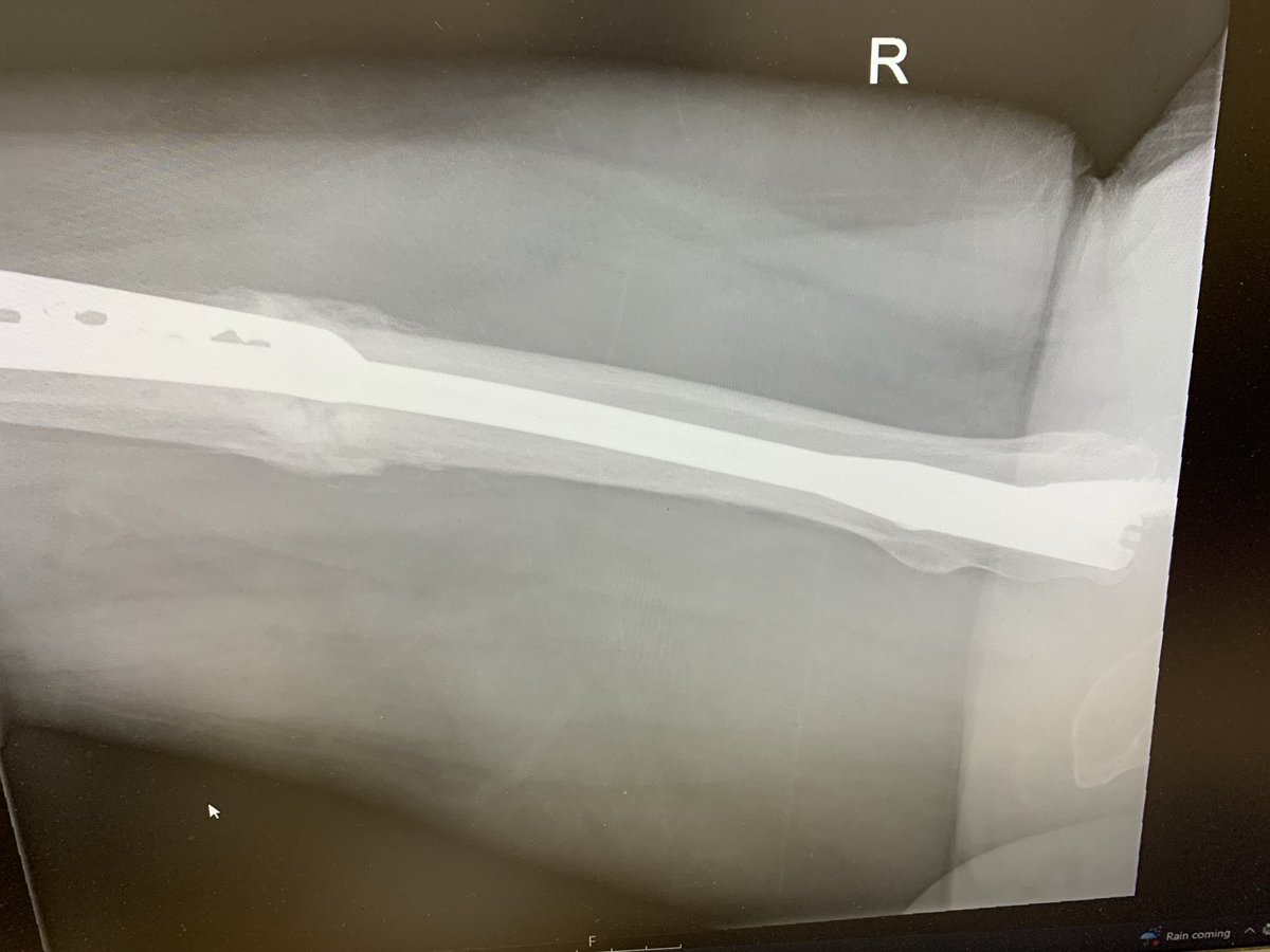 SP Orthopaedics tweet media