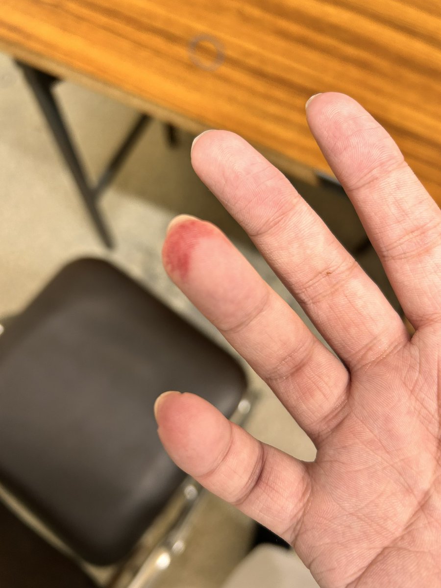 こんな内出血？見た事ねぇw
激痛