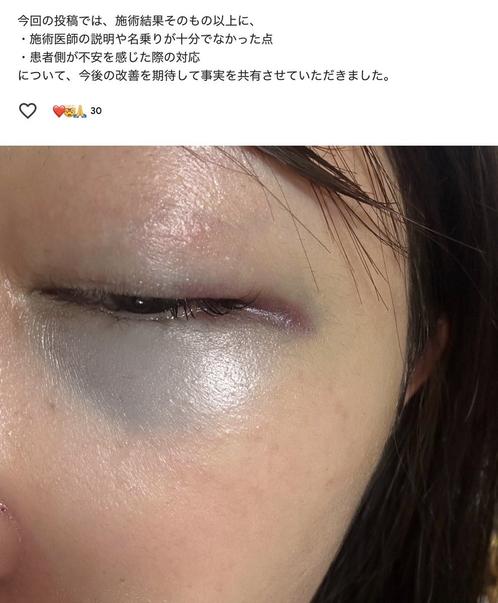 ototoxx's tweet photo. 施術するのに名乗らない医師ってどういう意味があるんだろ？？？

内出血は運要素もあるから仕方ないけど
医師の名前も分からないとすごく不安になると思う😰 https://t.co/a1cuVXwc5o