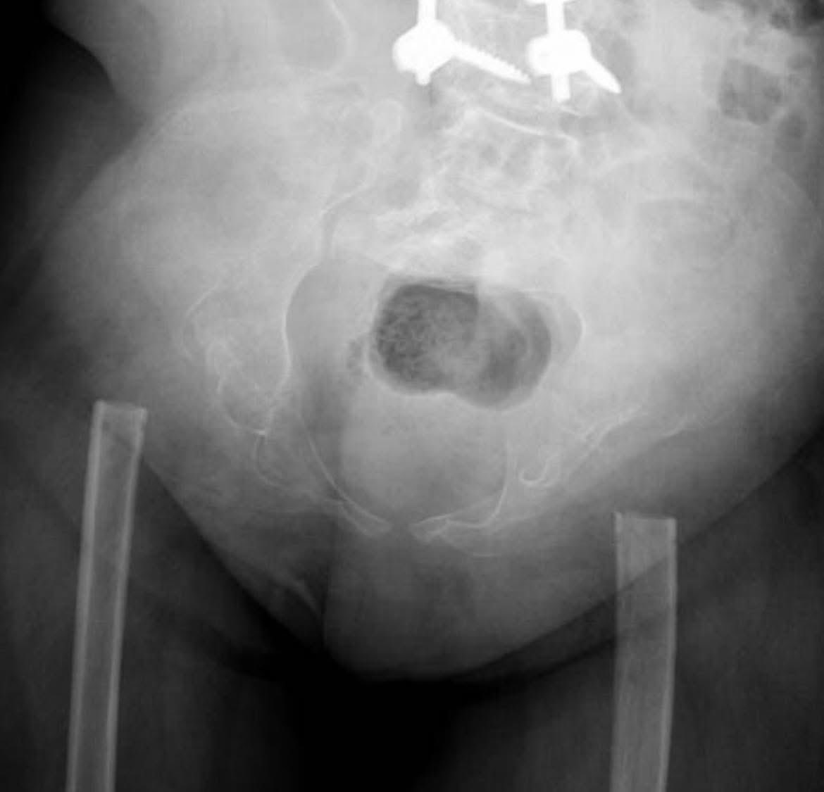 hemo_shk's tweet image. Clinical Pearl:

Based on this X‑ray.
What’s your diagnosis? 🩻

#Orthopedics #Xray #Health #Lifestyle