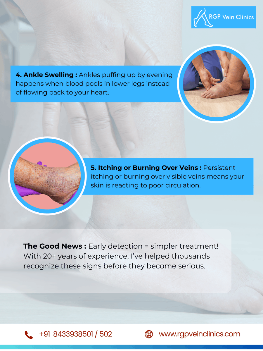 ProfRGPatil's tweet photo. Heavy, tired legs? 
Spider or bulging veins? 
Night cramps? 
Ankle swelling? 
Itching over veins?

These are early warning signs of varicose veins. 
Don’t ignore them. Early diagnosis means simpler treatment.
📞 +91 8433938501
🌐 https://t.co/FNatGeOtLl
#varicoseveins #veincare https://t.co/kErWCcCVPh