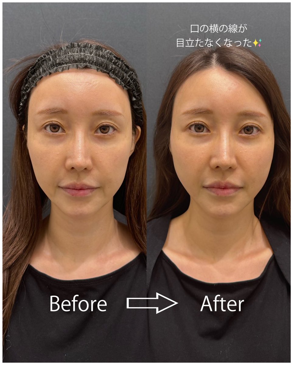 【糸リフト価格改定❣️】
初めての方やメンテナンスの方へ
お得に受けていただくため
価格の改定を実施しました🥰

ｲﾃｳｫﾝﾋﾞｭｰﾃｨｰｸﾘﾆｯｸでは
糸リフトの症例数ランキングに
ランクインしている実績のある医師が
在籍しています👀👑
【ご予約はこちらから👇🏻】
s.s-b-c.net/dyplz9an