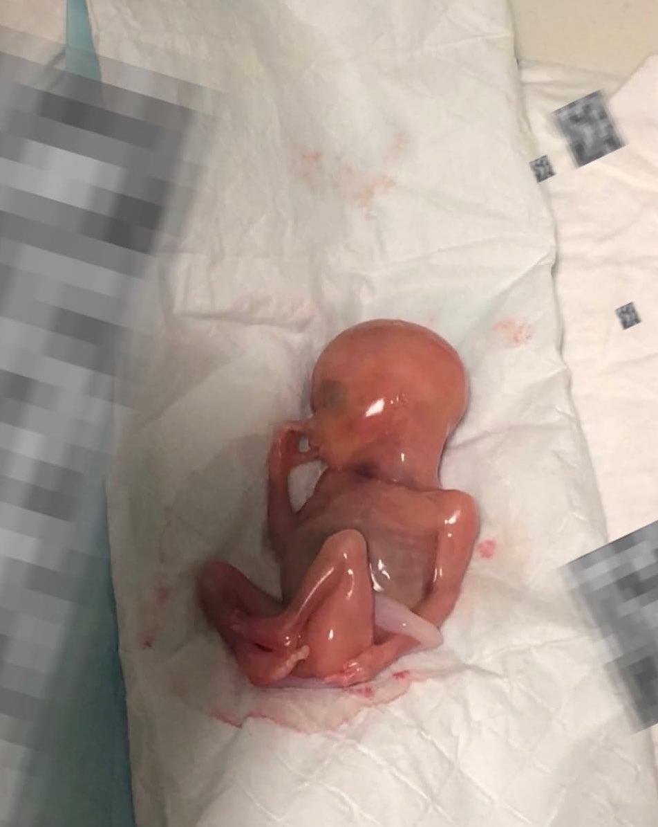 duquecp2's tweet photo. Chamam o aborto de “questão de saúde pública”. Imagem forte ->

Mas quando um bebê sobrevive a um aborto e nasce com vida, já não estamos diante de uma estatística, nem de um discurso, nem de um termo técnico. Estamos diante de uma vida humana concreta, frágil e indefesa.

Se há vida, há dever de cuidado. Se nasceu com vida, a resposta deveria ser assistência médica, proteção e dignidade — não abandono.

Como é possível olhar para um bebê que sobreviveu e ainda reduzir tudo a uma “questão de saúde pública”? Em algum momento, as palavras deixam de ser neutras e passam a esconder a realidade que está diante dos olhos.