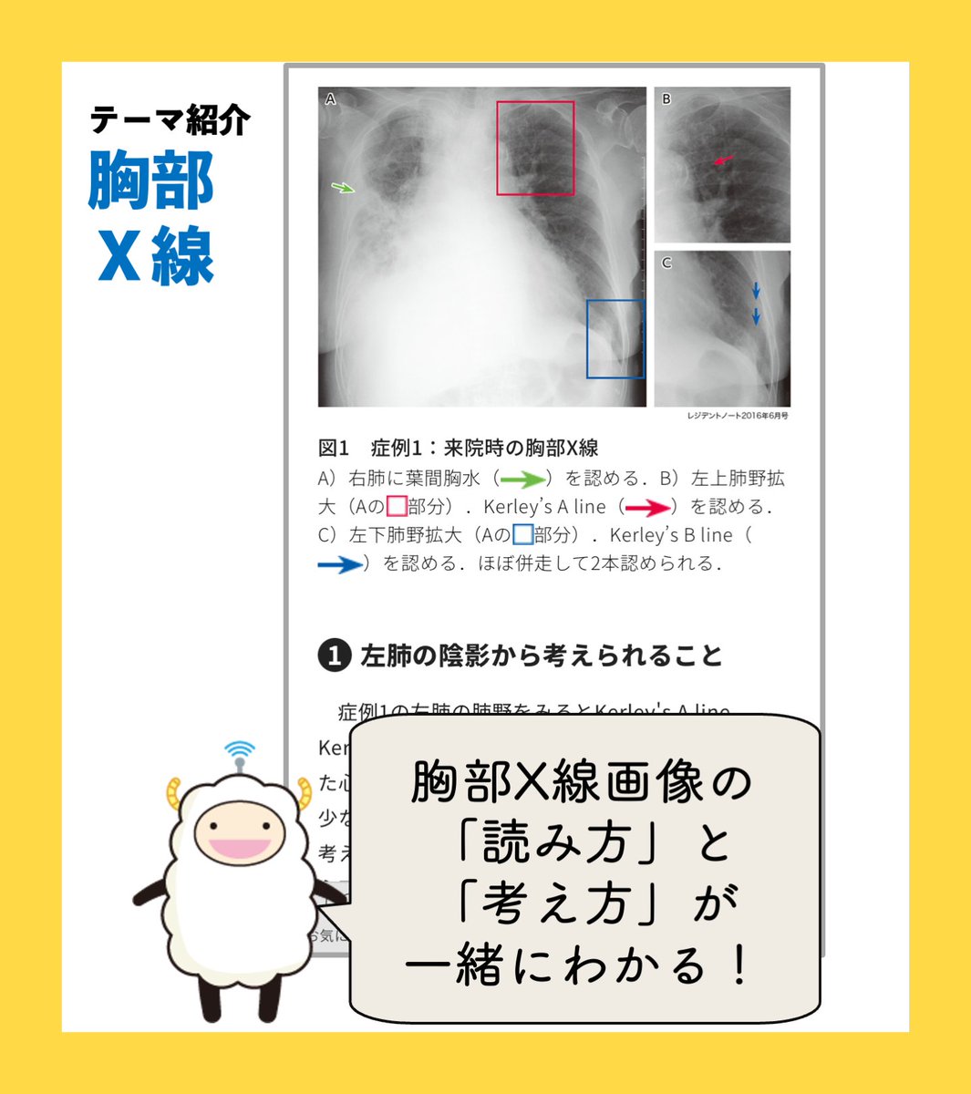 Yodosha_RN's tweet photo. “実臨床”でぜったい必要！なテーマ　その１
🍀『胸部X線』🍀
基本の読み方とそのプレゼン方法、疾患ごとの画像所見の特徴をおさえよう！

《研修医になる前に必ず読んでください。2026》で読めます（いまなら40%OFF！）
https://t.co/ZeprP0VHrV https://t.co/eygyERUme4