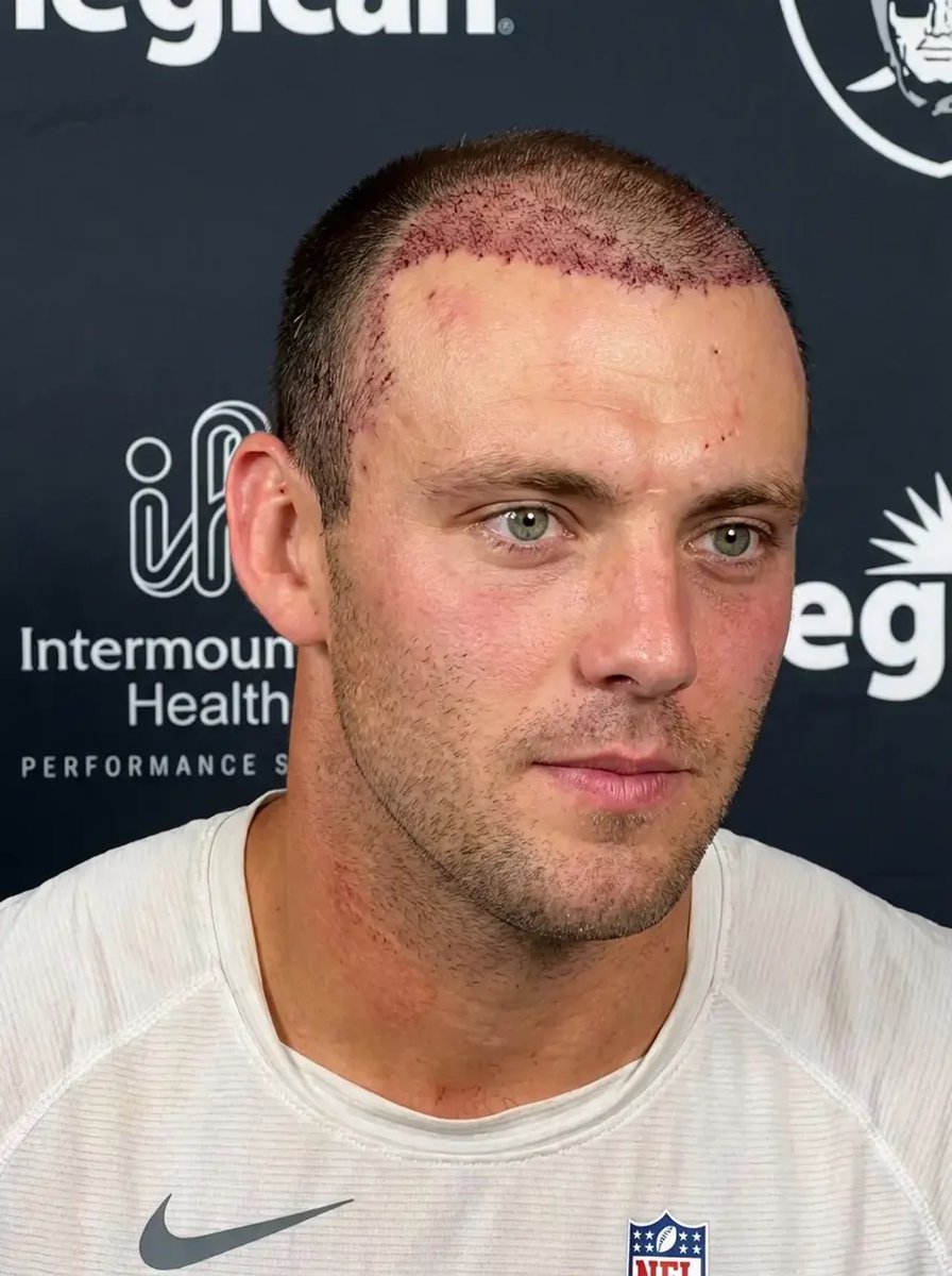 REPORT: 
#Raiders TE Brock Bowers recently traveled to Turkey to undergo a hair transplant procedure, per source.

The procedure was described as “routine” and “purely cosmetic.”

Bowers is expected to make a full recovery and be at 100% for offseason activities.