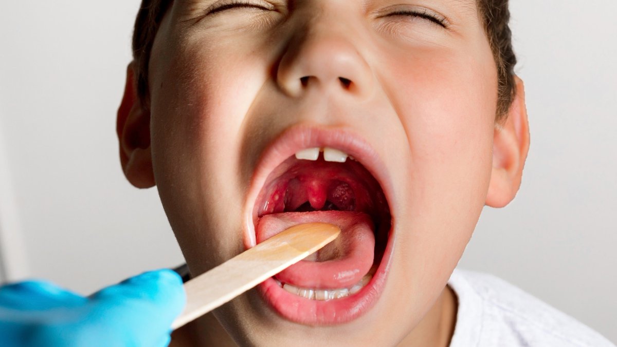 PharmFavourC's tweet image. TONSILLITIS: When Swallowing Feels Like Fire 

Does your throat hurt so badly that even water feels painful to swallow?
It might be Tonsillitis.