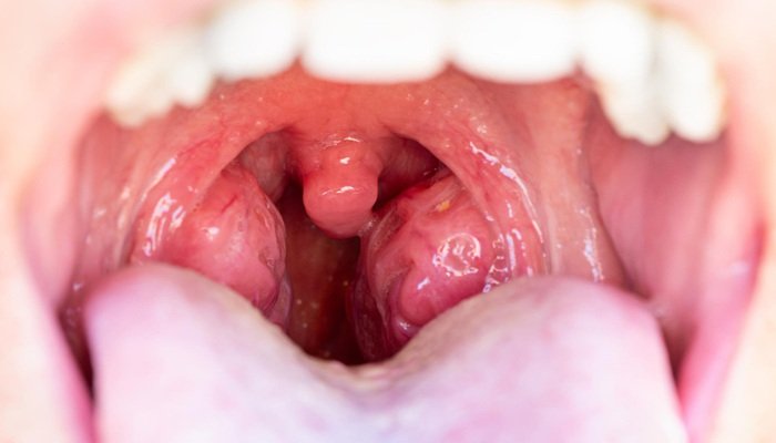 PharmFavourC's tweet image. TONSILLITIS: When Swallowing Feels Like Fire 

Does your throat hurt so badly that even water feels painful to swallow?
It might be Tonsillitis.