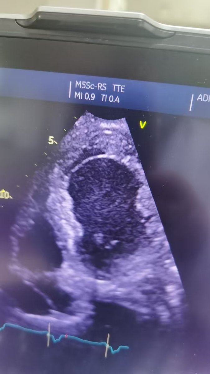 ll_Bamboo's tweet photo. Left Ventricular Pseudoaneurysm？ https://t.co/zdZ10M9xaN