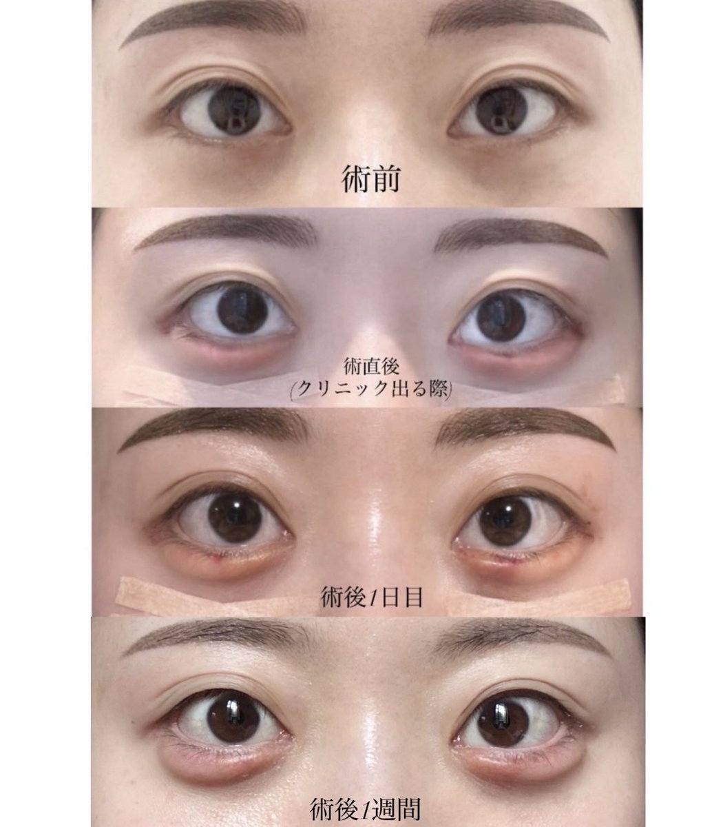 li_04_0's tweet photo. ファクト美容外科さんで【涙袋脂肪移植】を行ってもらいした✨✨
内出血が無くなってぷっくりした涙袋ができてきました❤️❤️
涙袋が自然な形でメイクするのがすっごい楽しいです💖
術前 → 術直後 → 術後1日目 → 術後1週間後 → 術後1ヶ月です！

@fact_psjp https://t.co/dAUAg9CU4v