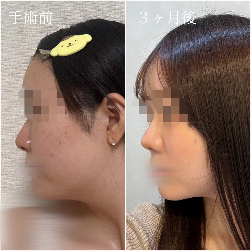 oh_bb_dd's tweet photo. 術後3ヶ月です。
傷跡も気にならなくなり、理想通りのナチュラルで綺麗な鼻になりました✨️
周りからも綺麗になったと言われることが多くあり、やって良かったと心の底から思います。

ありがとうございます！
@345plastic

#ノープロテーゼ鼻整形 #鼻整形 #韓国整形 #345美容外科 https://t.co/6gFLKcasH6