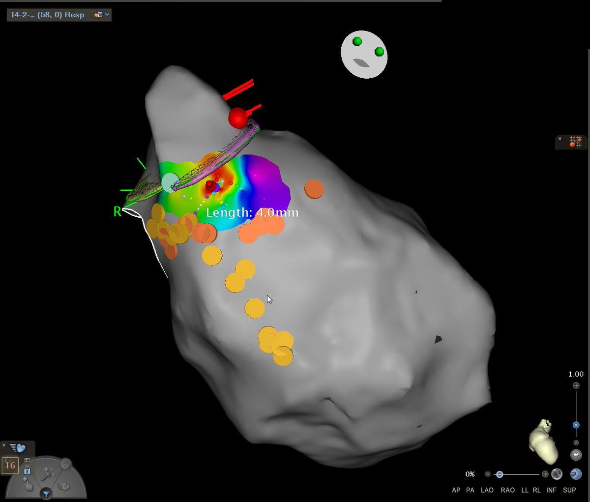 Pat_Nawong's tweet photo. Proud milestone at Pali Momi: Hawaiʻi’s first zero-fluoro complex VT ablation using new SOUNDSTAR Crystal high-definition ICE.

Precision VT ablation without radiation: bringing cutting-edge EP to Hawaii 🌺⚡️

#VTAblation #ZeroFluoro #EPeeps

@prasitlumkum @JNJMedTech @TFern5334 https://t.co/JskWX8AkuO