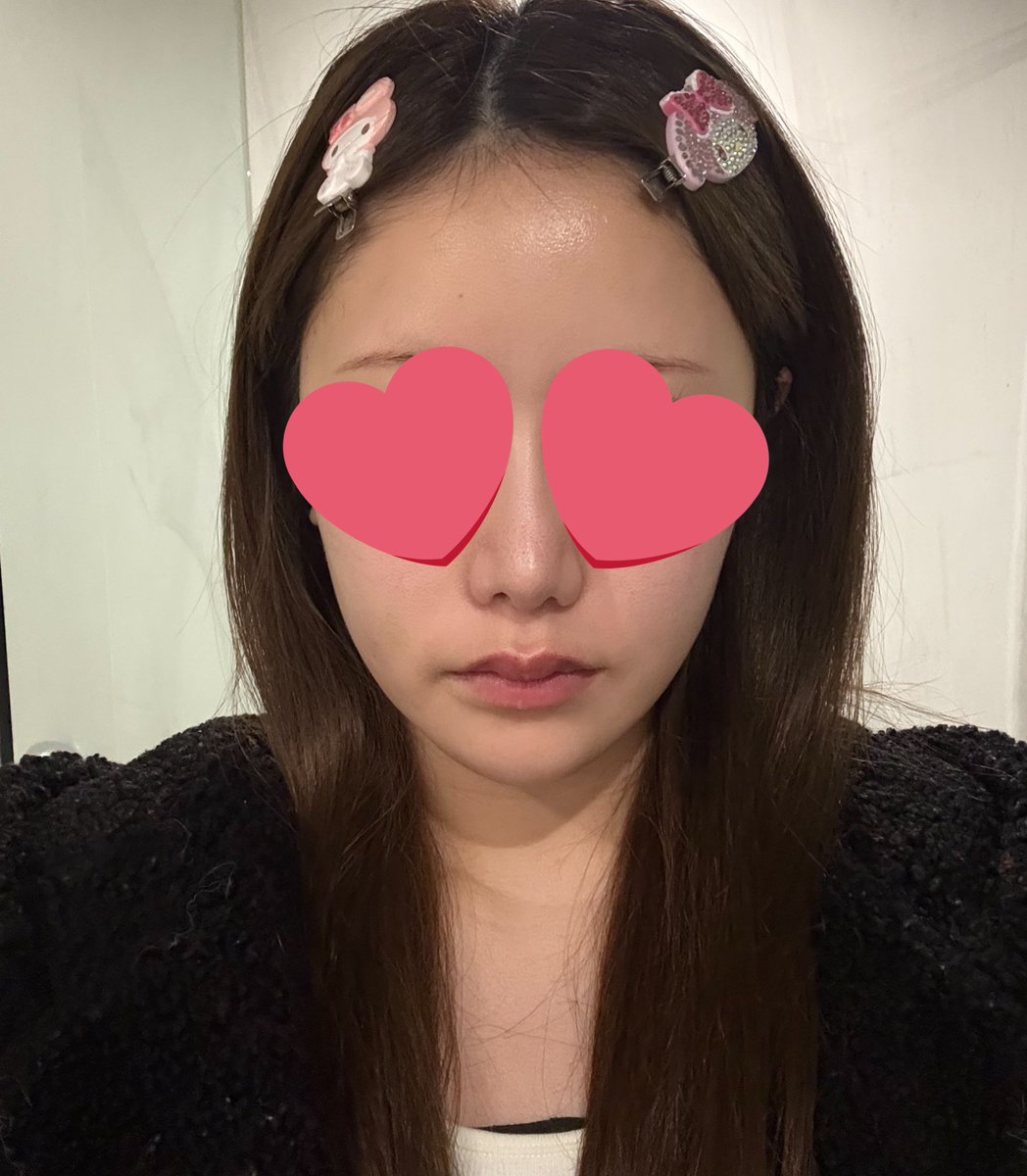 93r229lv's tweet photo. 輪郭3点 術後7ヶ月目
#ビュー美容外科 https://t.co/lVRlJLjRJO