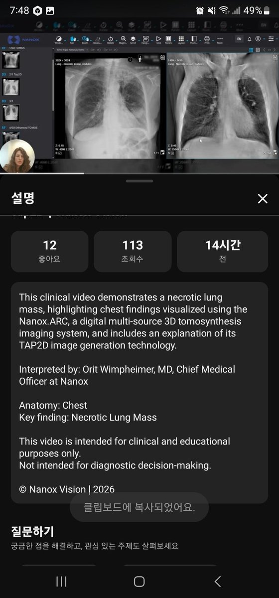 $nnox $ai
This clinical video demonstrates a necrotic lung mass, highlighting chest findings visualized using the Nanox. ARC, a digital multi-source 3D tomosynthesis imaging system, and includes an explanation of its TAP2D image generation technology.
youtu.be/oP3nyZ4ViMM?si…