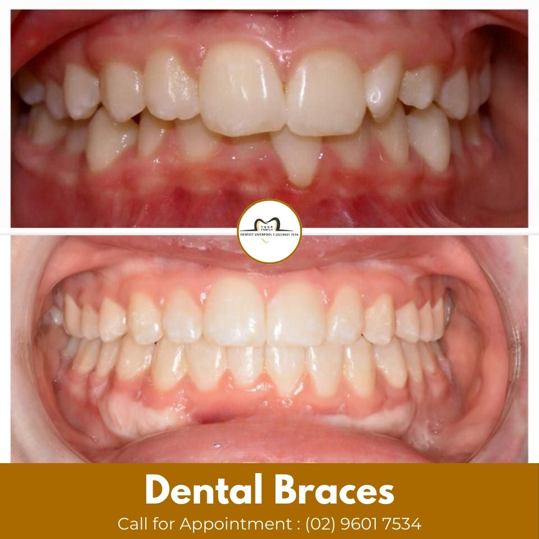YfdlYfdl181417's tweet image. Braces don’t just improve appearance—they can also help with alignment, bite, and long-term oral health.
We’ll assess your teeth and recommend the best treatment plan for your smile.
.
.
.
.
#DentalBraces #OrthodonticsSydney #TeethAlignment #BiteIssues #CrowdedTeeth
