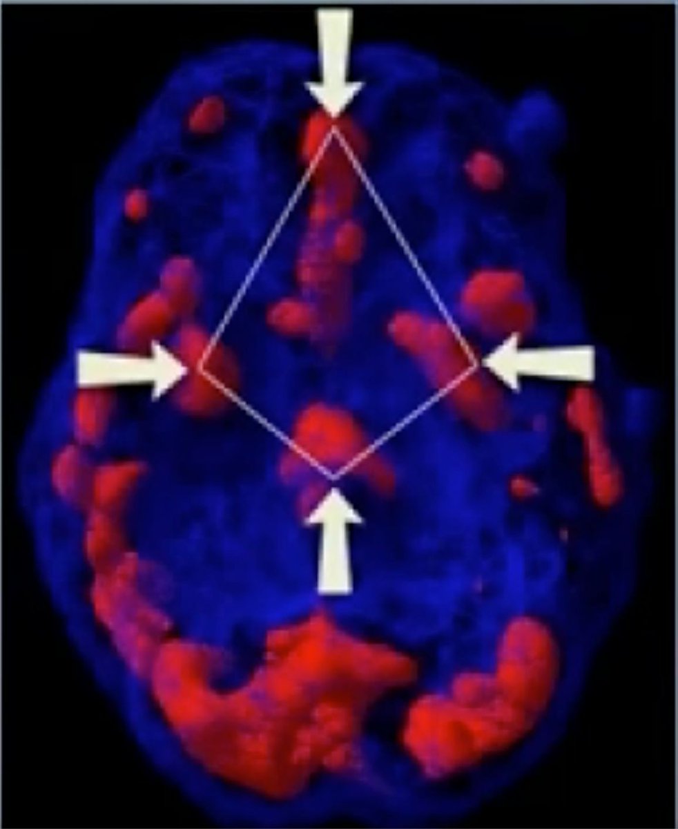 LFECHGR's tweet photo. The Brain on Fire: PTSD & The Diamond PatternImagine your brain as a complex city. For those with PTSD, certain districts are constantly ablaze, creating a "diamond pattern" of overactivity. Does this resonate with your experience?PTSD isn't just about reliving memories; it's about a brain stuck in a perpetual state of emergency. This isn't a flaw in your character, but a measurable physiological reality. Understanding this can be the first step towards finding a solution that truly works.Dr. Daniel Amen's SPECT scans reveal a distinct "Diamond Pattern" in the brains of individuals with PTSD...four key regions showing overactivity. This visual evidence confirms that trauma leaves a physical signature. FSM aims to gently re-regulate these overactive areas, helping your brain find its way back to balance.Your brain isn't broken; it's just stuck. Discover how FSM can help re-pattern your brain for peace and calm. Learn more about the science: https://t.co/lgZ8P4gjwW #PTSDBrain #DiamondPattern #FSMforPTSD #BrainHealth #WaymakerzScience
