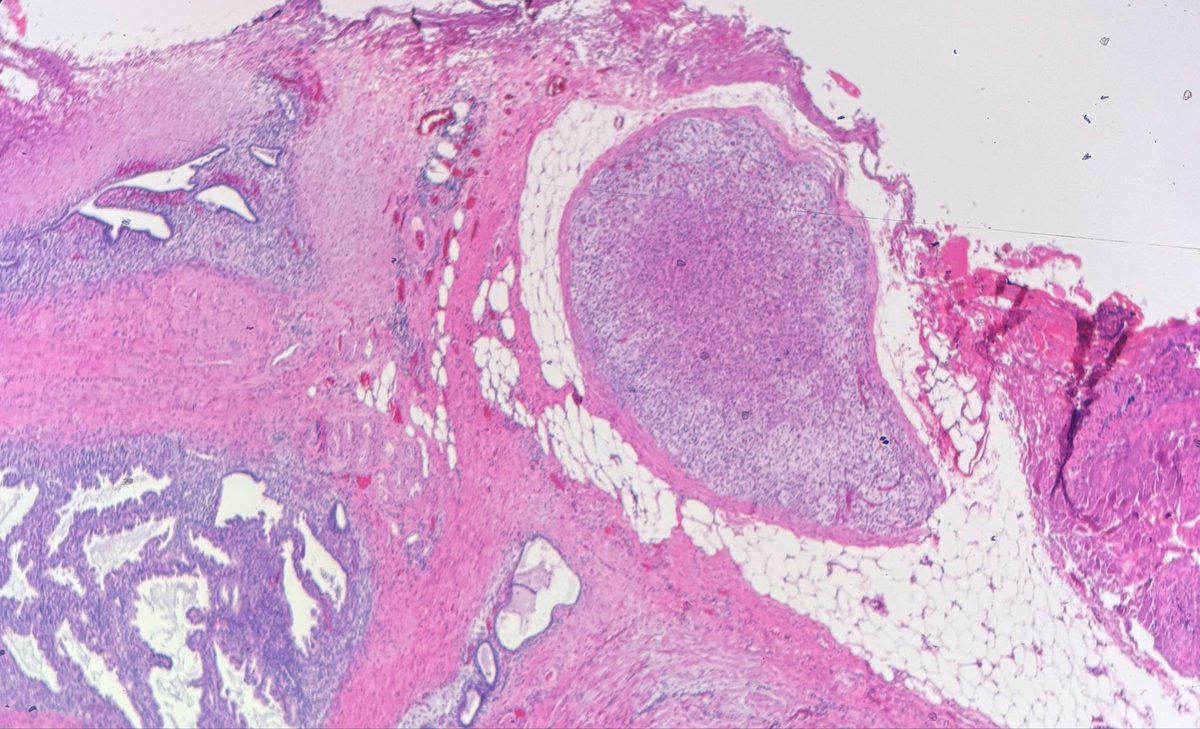 Janiranavarro's tweet photo. Adrenal rest and endometriosis in fallopian tube 

Adrenal rest (Pic 1 and 2)
Endometriosis (pic 1)

#everydayGYN #pathology #PathX #pathtwitter https://t.co/9erDoQ1knK