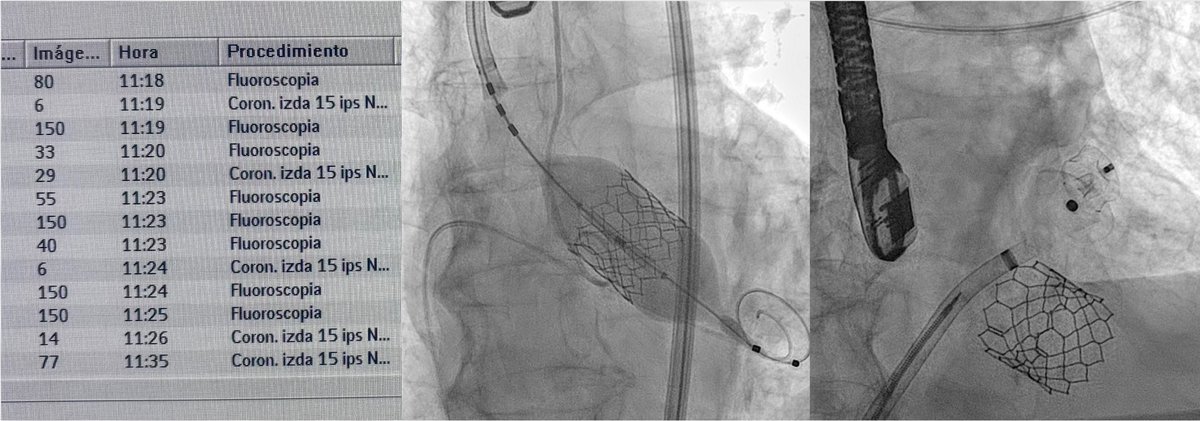 HMHemodinamica's tweet photo. Vuelve la TAVIjuela! TAVI+cierre de orejuela en poco más de 30 min y con 60cc de contraste💪!! La combinación de procedimientos percutáneos permite ahorrar costes, optimizar recursos y reducir las molestias al paciente y a sus acompañantes. La clave es planificación con imagen🙌🏻 https://t.co/Tx82F4gCZR