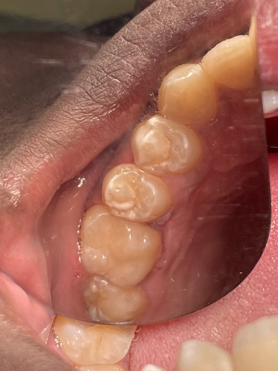 خميس ورمضان والمريض ماسحب عليك ياسلام 🤍
 Today's Case :  Deep Class l on 26 
It was restored with two layers 1st was GIC then the final layer Composite .