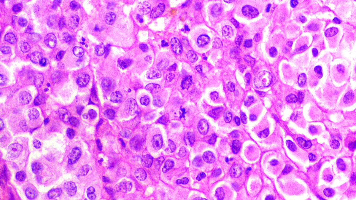 _Wondweson64's tweet image. ᴀ 16 ʏʀ 👩 | ᴍɪᴅᴅʟᴇ ᴄʀᴀɴɪᴀʟ ғᴏssᴀ ᴇxᴛʀᴀ-ᴀxɪᴀʟ ᴍᴀss🧠.
🌒 Rʜᴀʙᴅᴏɪᴅ ᴍᴇɴɪɴɢɪᴏᴍᴀ
#pathx #pathology #CNSpath #pathresidents #pathoutpic