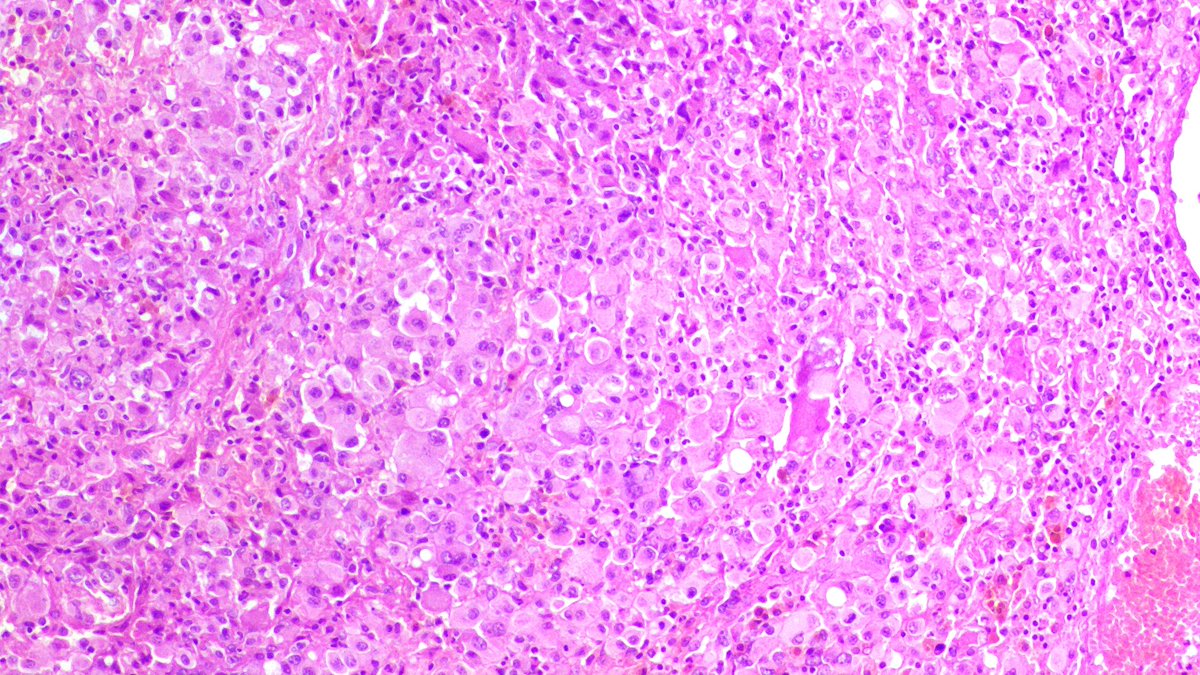 _Wondweson64's tweet image. ᴀ 16 ʏʀ 👩 | ᴍɪᴅᴅʟᴇ ᴄʀᴀɴɪᴀʟ ғᴏssᴀ ᴇxᴛʀᴀ-ᴀxɪᴀʟ ᴍᴀss🧠.
🌒 Rʜᴀʙᴅᴏɪᴅ ᴍᴇɴɪɴɢɪᴏᴍᴀ
#pathx #pathology #CNSpath #pathresidents #pathoutpic