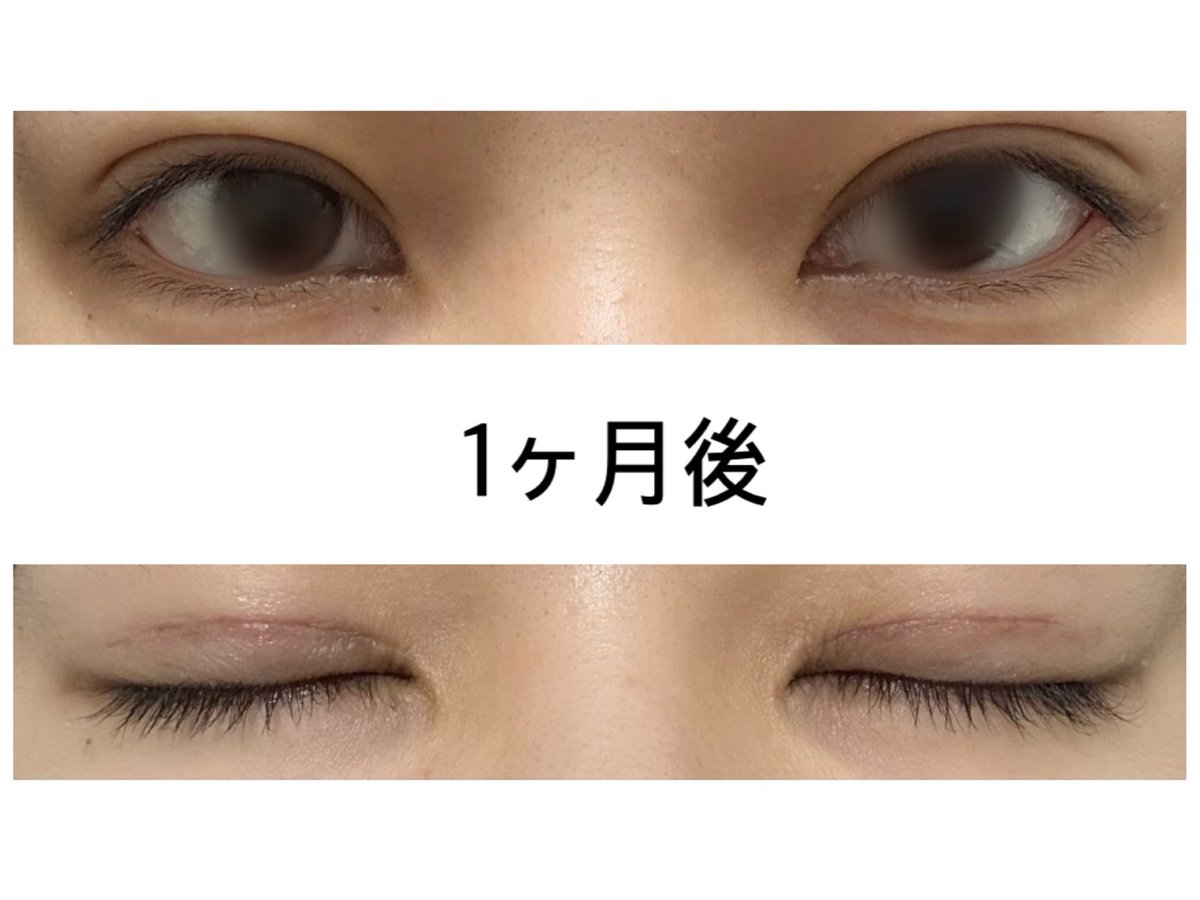 BrRt7s's tweet photo. 二重切開して1ヶ月
開眼時反射してしまったのでモザイク https://t.co/VVnwjKFAgp