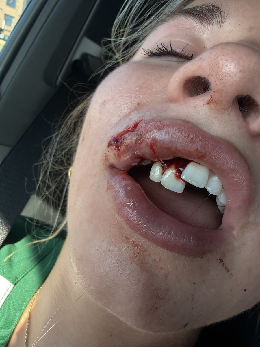 MaddyBertsch27's tweet photo. I had a terrible facial impact 10 days ago.  Made my return last night and put my stamp on it.  @CoastRecruitsSB @scan1ansports @ExtraInningSB https://t.co/8gzGL7yeBl