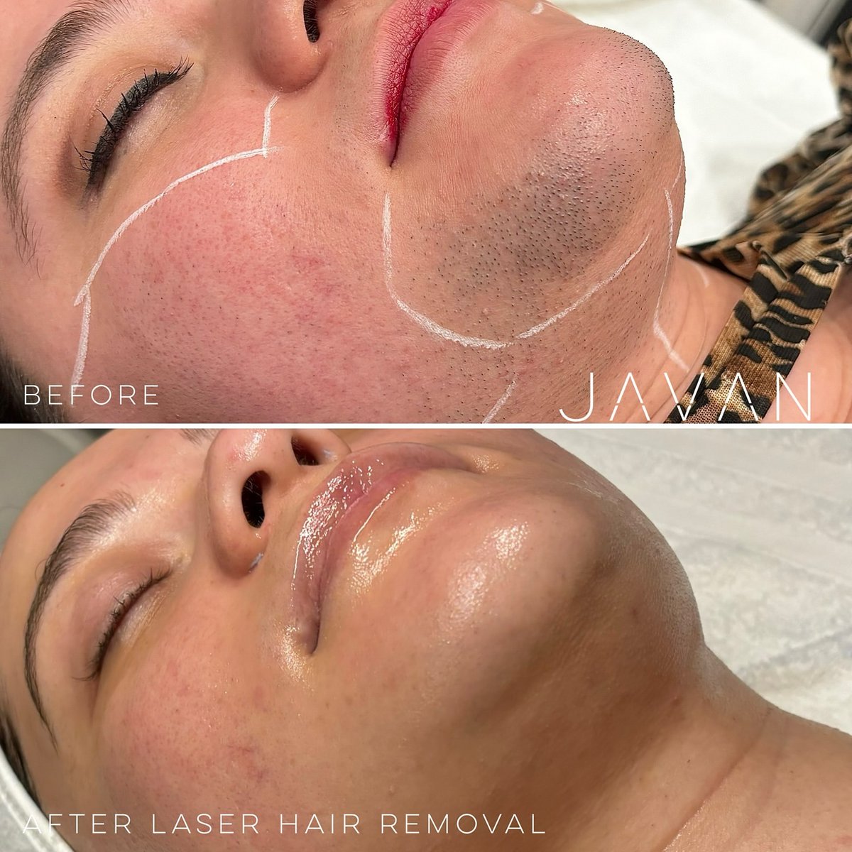 CandelaMedical1's tweet photo. Check out these fabulous results from @skindollbre &amp; @javanwellness with the GentleMax Pro!

“This patient saw many other providers at different practices, tried different lasers and saw no improvement. Hearing the words “you changed my life” is EXACTLY why I do what I do”

#PCOS https://t.co/kvuzQxHC5S