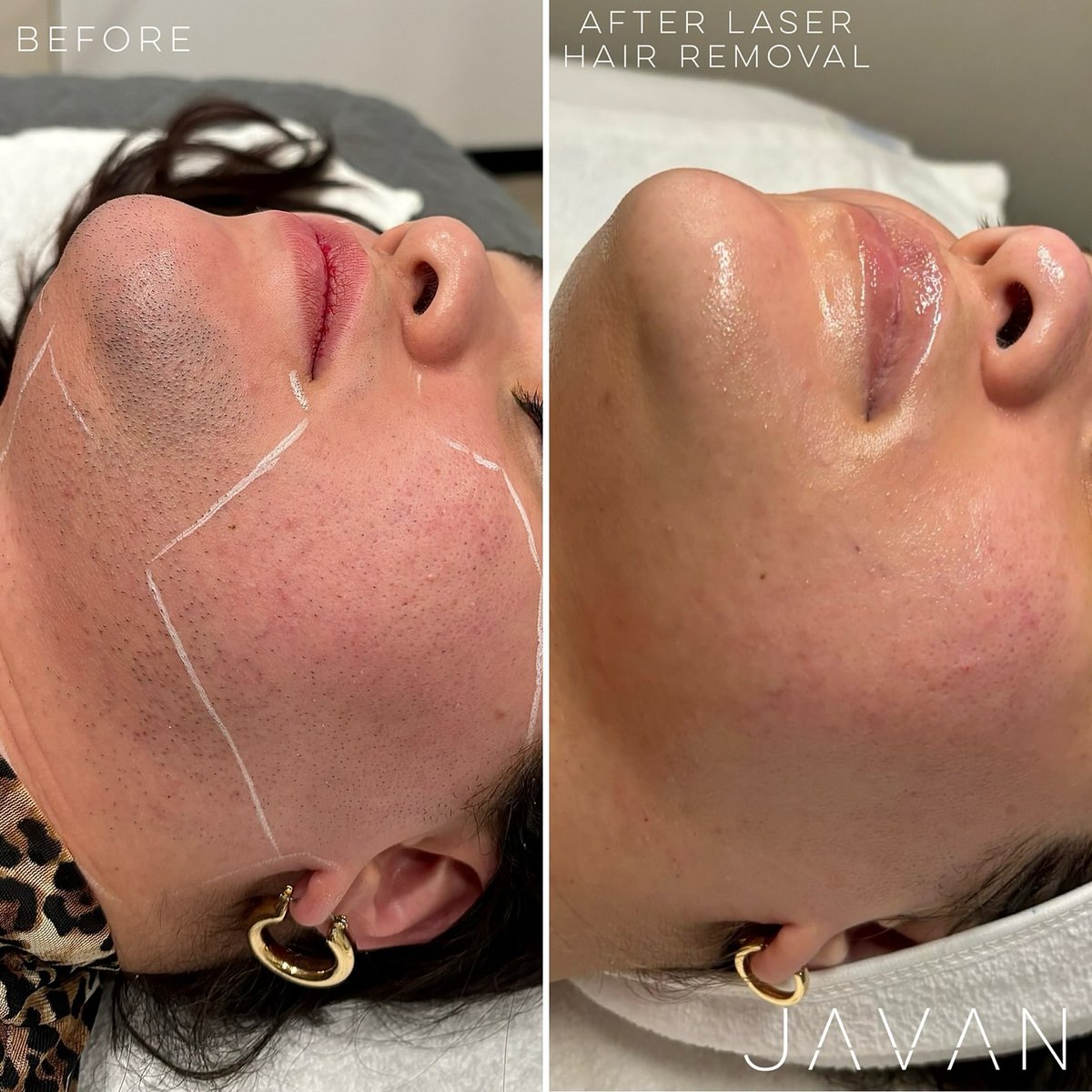 CandelaMedical1's tweet photo. Check out these fabulous results from @skindollbre &amp; @javanwellness with the GentleMax Pro!

“This patient saw many other providers at different practices, tried different lasers and saw no improvement. Hearing the words “you changed my life” is EXACTLY why I do what I do”

#PCOS https://t.co/kvuzQxHC5S