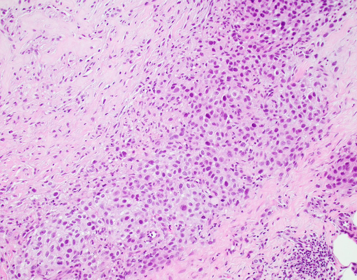 fouad_boulos's tweet photo. Sorry for the long silence. This is a quick in-house case I had to share.

Breast mass, 2 cm. High grade, central fibrosis, lymphoid infiltrate, ER/PR/HER2 negative. Classic TNBC. Correct?

Incorrect. History of melanoma, discovered by chance, not mentioned anywhere in the pathology requisition, casually buried in a random note.

How scared should we be? How often should we work-up triple-negative tumors in search of some odd metastatic lesion? How many of you would have worried about this and investigated it further in the absence of history? I certainly wouldn't have.

Good luck staying safe and cautious without spiraling down into the abyss of obsession and paranoia.

IHC: Melan-A

#melanoma #breastcancer #breastpath @washupathedu @washu_pathology