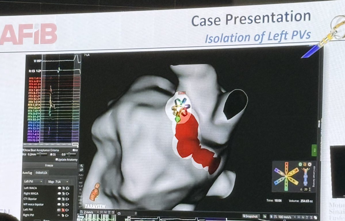 KTamirisaMD's tweet photo. #WesternAFib 
@EPLabDigest 
Here we go! Day #1 

Elevate PF trial 
Impedance based (not force sensing) 
Lesion durability with 
Faraflex + feasibility/effectiveness Dr. Vivek Reddy 
@nmarrouche @netta_doc 
#EPeeps 
Wait for final data at @HRSonline annual meeting! https://t.co/uIlHrqaX3H