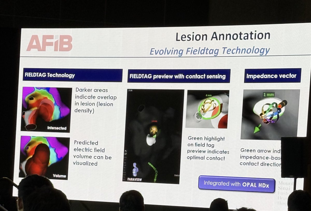 KTamirisaMD's tweet photo. #WesternAFib 
@EPLabDigest 
Here we go! Day #1 

Elevate PF trial 
Impedance based (not force sensing) 
Lesion durability with 
Faraflex + feasibility/effectiveness Dr. Vivek Reddy 
@nmarrouche @netta_doc 
#EPeeps 
Wait for final data at @HRSonline annual meeting! https://t.co/uIlHrqaX3H