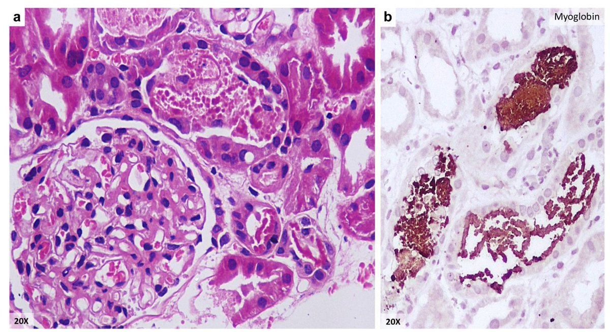 KIReports's tweet image. Histopathological Spectrum of  #Acute #Kidney #Injury After #Wasp Sting #Envenomation

 doi.org/10.1016/j.ekir…

#KIRResearchLetter