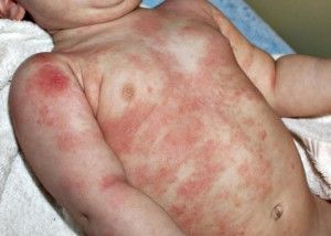 Can you imagine what it feels like to be able to administer the principles of Heilkunst Medicine to help a child out of the matrix of this kind of suffering? What an honour ... every . single . day. arcanum.ca/2015/11/18/mav…