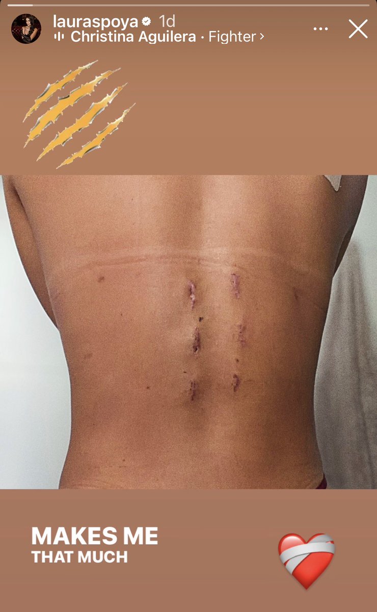 Entonces, Laura Spoya nos muestra los tornillos que le pusieron en la espalda…
Espero que hayan aprovechado en ponerle el que le faltaba en la cabeza!