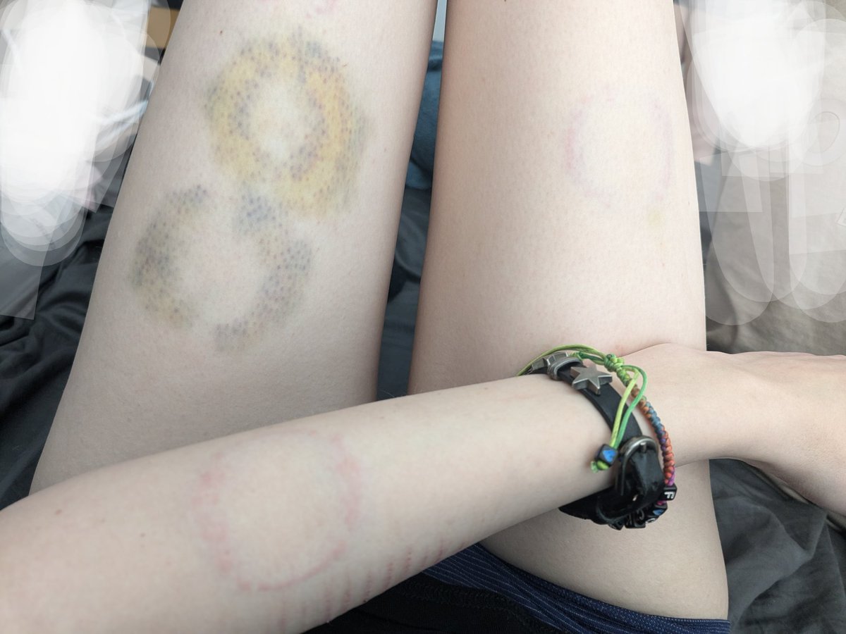 abbiekittens's tweet image. throwback to when I got chewed tf up