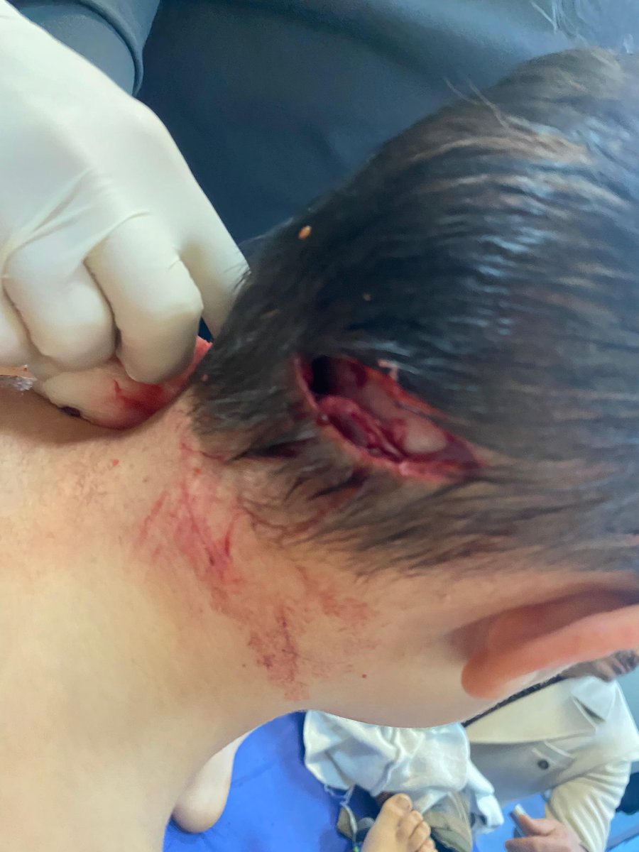 Muş…

5 yaşındaki Talha ve annesinin kuduz başıboş köpek tarafından saldırıya uğradığını, çocuğun baş bölgesinden parçalandığını ve acil olarak ambulans uçak ile Ankara’ya hacettepeye getirildiğini, tedavisinin devam ettiğin, annenin Muş’ta tedavi edildiğini yazmıştım…

Talha