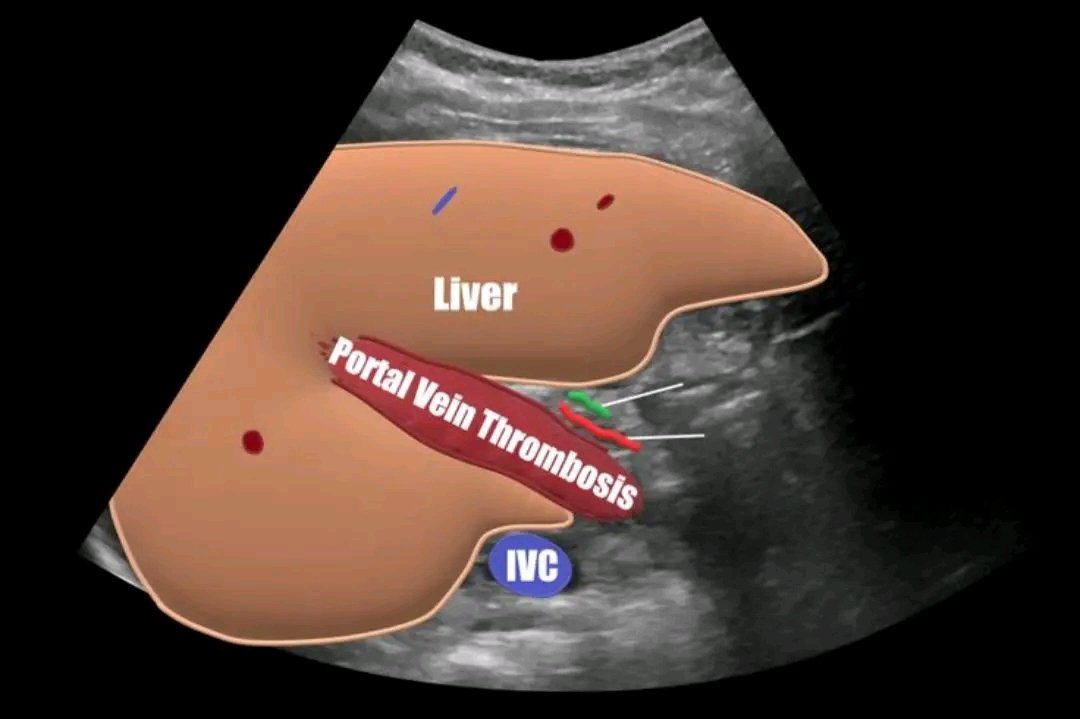 mznljrdy47597's tweet image. Portal vein thrombosis 

#ultrasoundscan #ultrasound #ultrasoundtech #post #PostViral