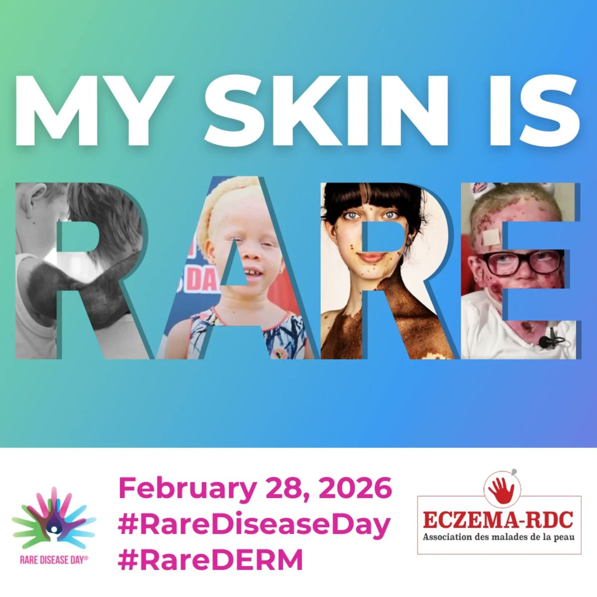 RdcEczema4128's tweet photo. Le 28 février est la Journée mondiale des maladies rares. Pour cette année, l'accent est mis sur la visibilité, la reconnaissance et le diagnostic rapide. Sous le thème "RENDRE VISIBLE L'INVISIBLE" #rarediseaseday #myskinisrare #globalskin https://t.co/9Z8J3cXjJX