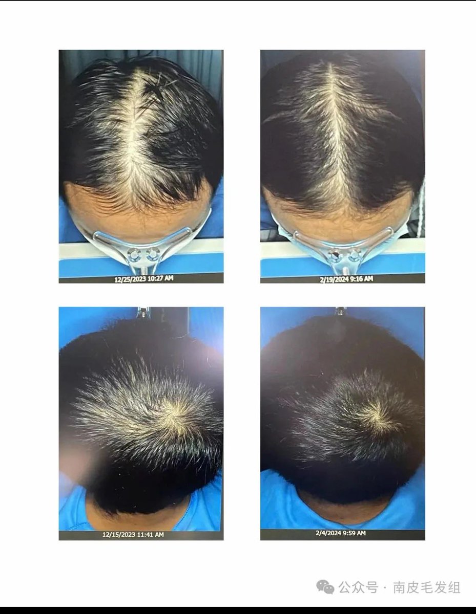 Goyim are still stuck with the DHT causes hair loss narrative while biotech is working on HMI-115 (potentially ~2027), a prolactin receptor blocker being developed for pattern hair loss and endometriosis.

For hair, finasteride 1mg increased hair count by ~+21 hairs/cm² vs